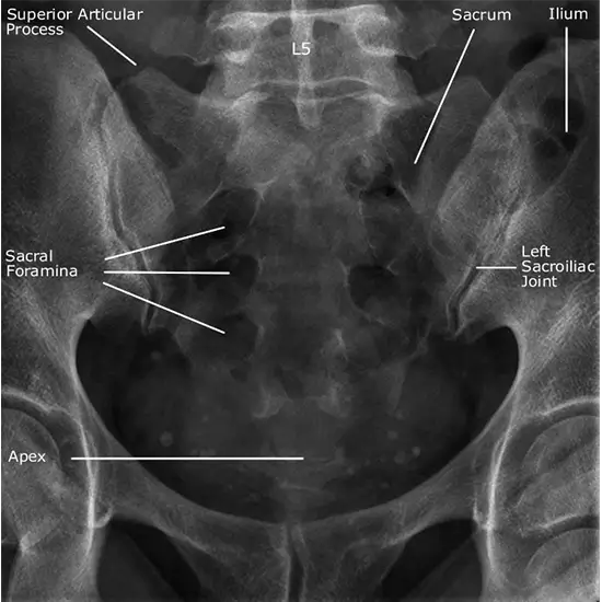 X-ray Sacral AP/Lateral